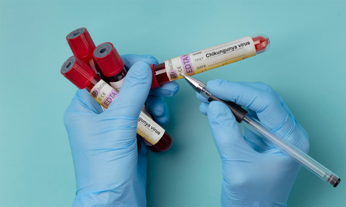 ALERTĂ în România: Primul caz de virus Chikungunya, confirmat la un bărbat venit din Africa