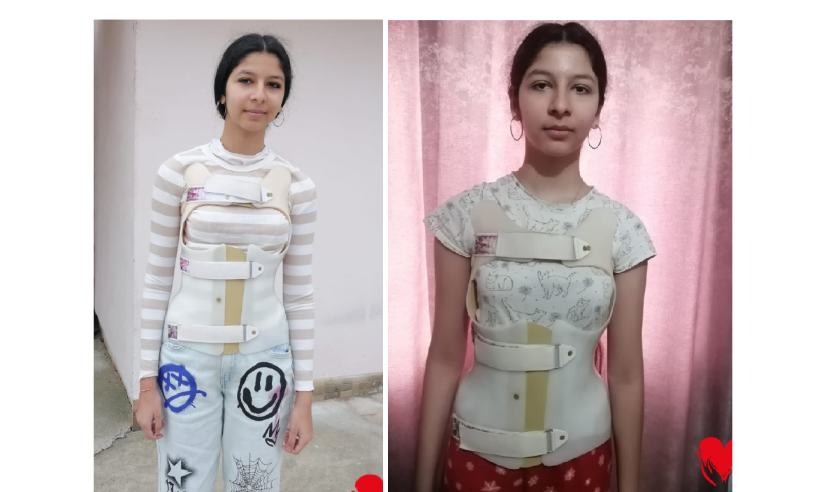 O afecțiune cruntă îi curbează coloana Erikăi, în fiecare zi: Operația este șansa mea, vă rog din suflet, ajutați-mă!