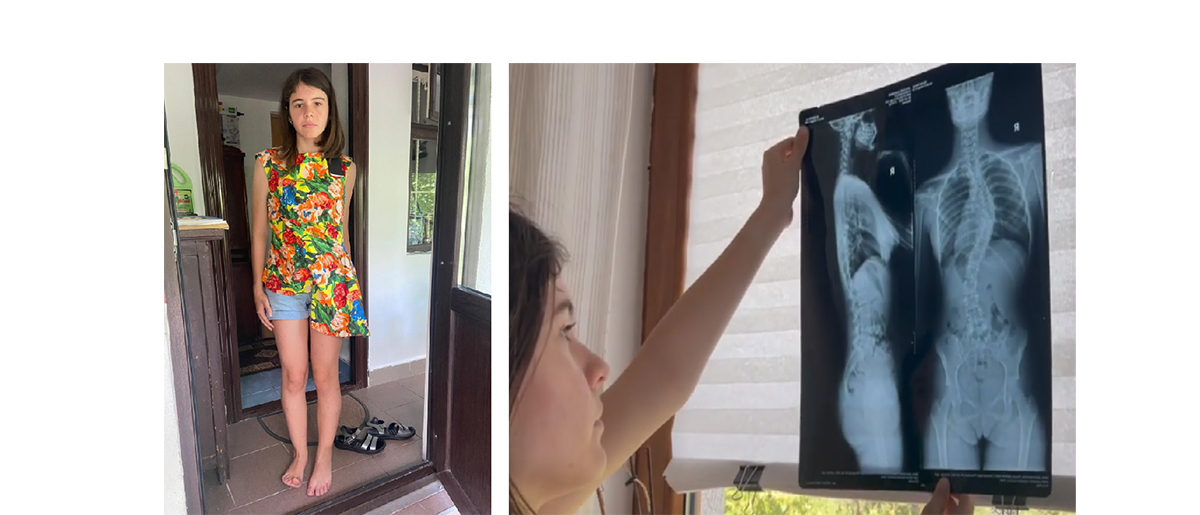 Vreau doar să nu mă mai DOARĂ: Diana are 12 ani și luptă cu deformarea severă a coloanei. Doar 7.000 de euro o despart de o operație CRUCIALĂ